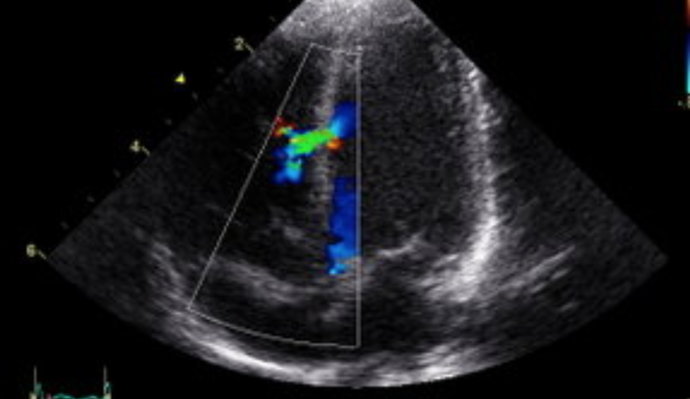 blunt-cardiac-injury-and-cardiac-contusion-echopraxis